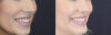 Lip Filler case #4178 slider thumbnail
