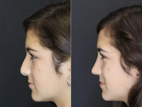 Rhinoplasty case #3967