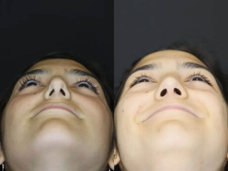 Rhinoplasty case #3967