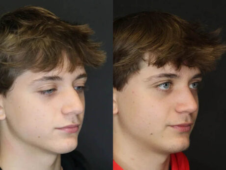 Rhinoplasty case #3982