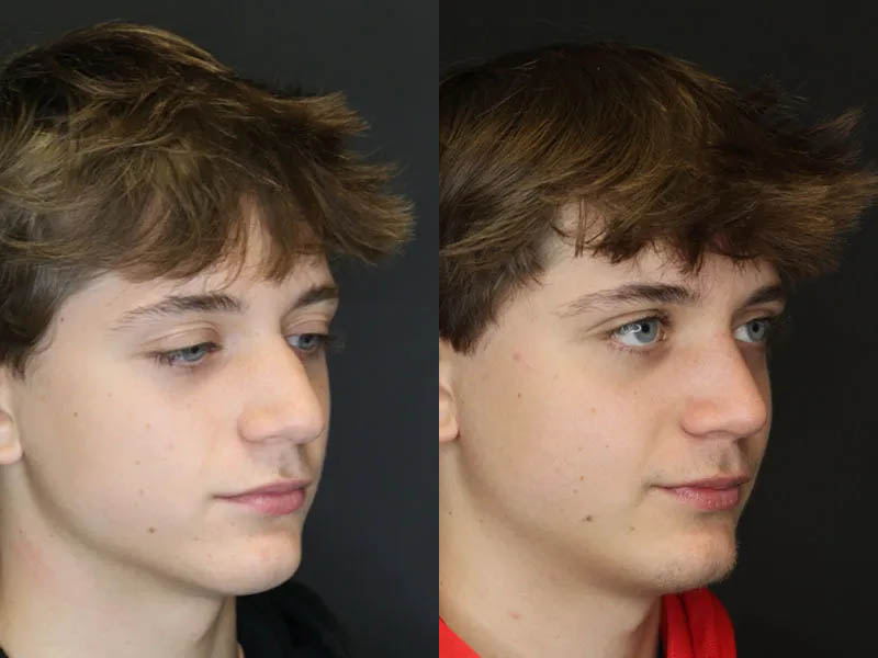 Rhinoplasty case #3982