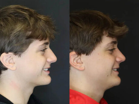 Rhinoplasty case #3982