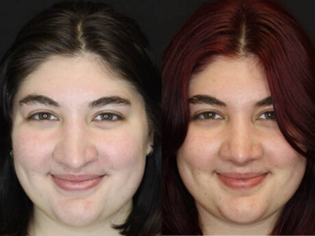 Revision Rhinoplasty case #4093