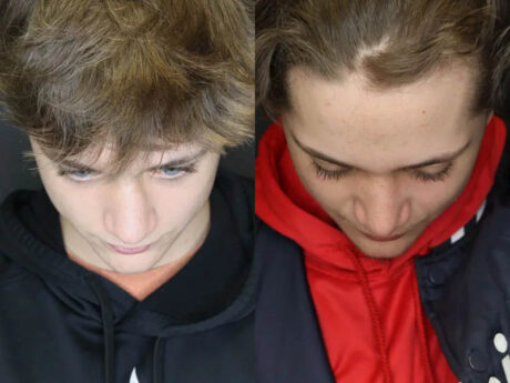 Rhinoplasty case #3982