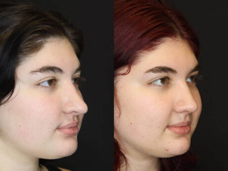 Revision Rhinoplasty case #4093