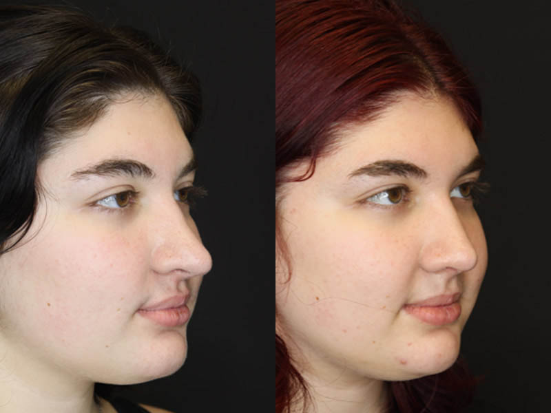 Revision Rhinoplasty case #4093