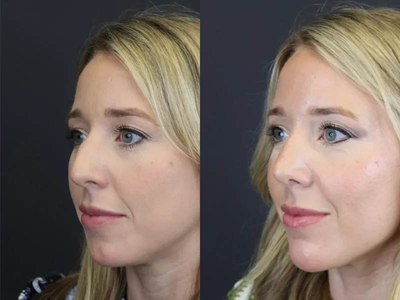 Facial Filler case #4115