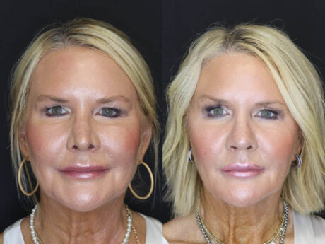 Revision Rhinoplasty case #4136