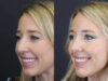 Facial Filler case #4115 slider thumbnail