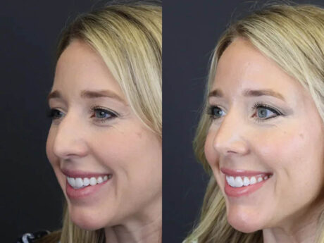 Facial Filler case #4115