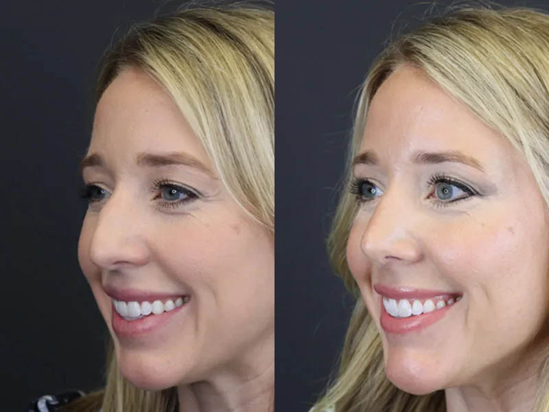 Facial Filler case #4115