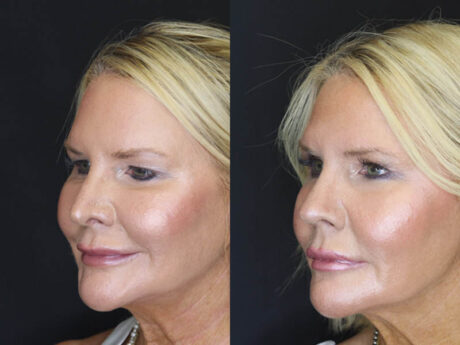 Revision Rhinoplasty case #4136