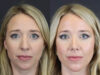 Facial Filler case #4115 slider thumbnail