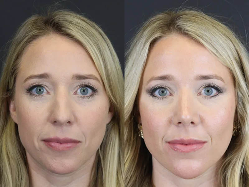 Facial Filler case #4115