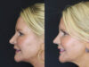 Revision Rhinoplasty case #4136 slider thumbnail