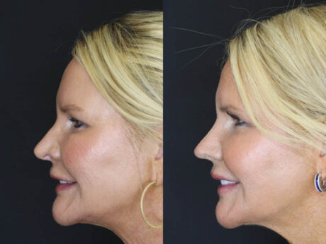 Revision Rhinoplasty case #4136
