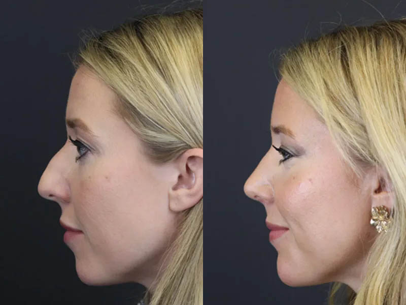 Facial Filler case #4115