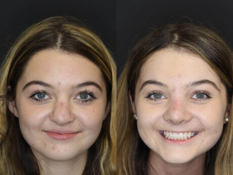 Revision Rhinoplasty case #4156