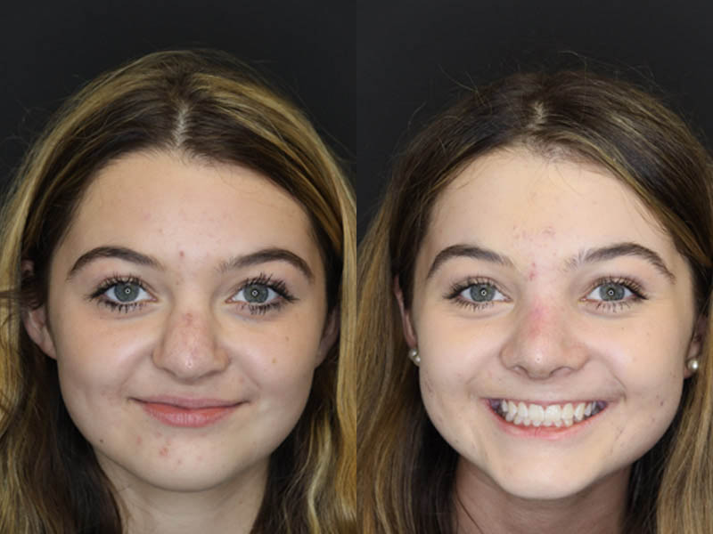 Revision Rhinoplasty case #4156