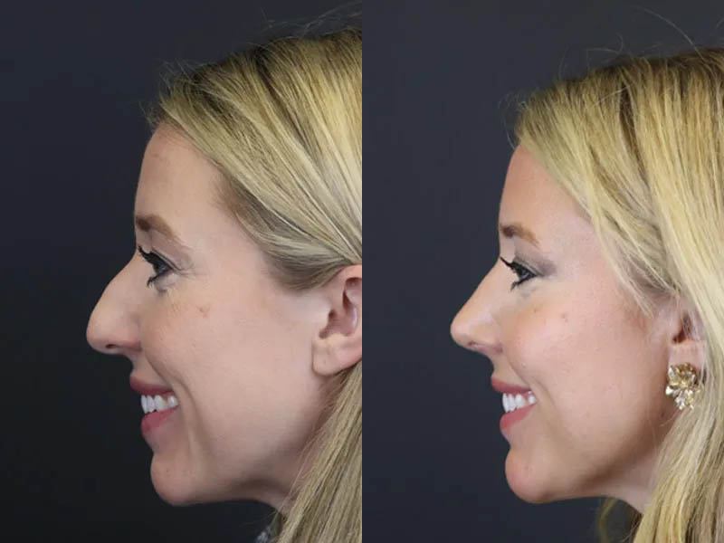 Facial Filler case #4115