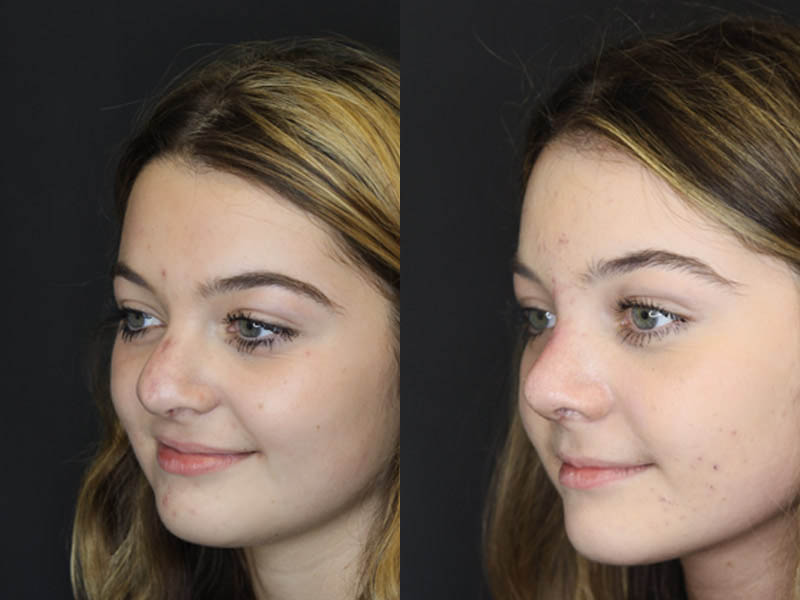 Revision Rhinoplasty case #4156