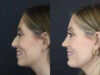 Chin Augmentation case #4143 slider thumbnail
