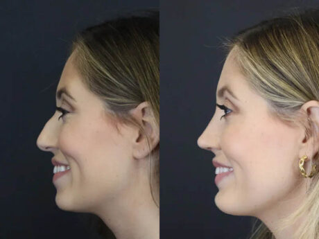 Chin Augmentation case #4143