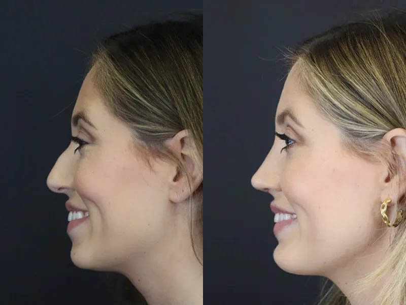 Chin Augmentation case #4143
