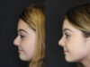 Revision Rhinoplasty case #4156 slider thumbnail