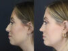 Chin Augmentation case #4143 slider thumbnail