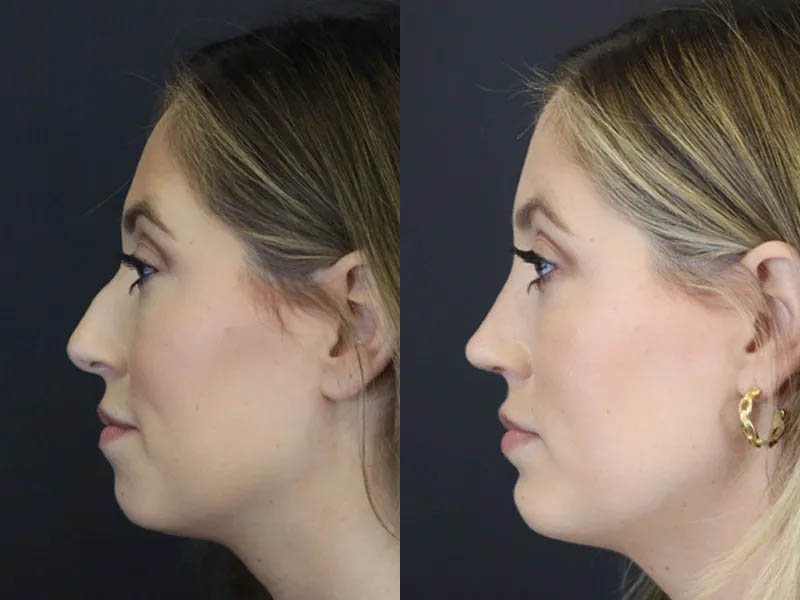 Chin Augmentation case #4143