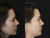 Rhinoplasty case #4163 slider thumbnail
