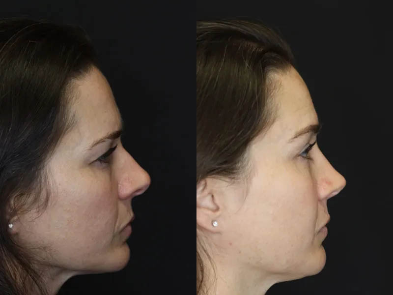 Rhinoplasty case #4163
