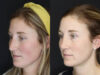 Revision Rhinoplasty case #4221 slider thumbnail