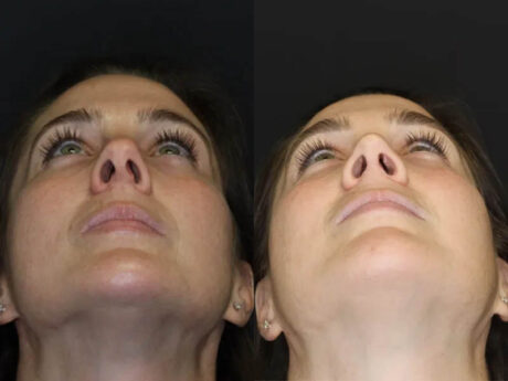 Rhinoplasty case #4163