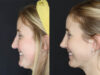 Revision Rhinoplasty case #4221 slider thumbnail