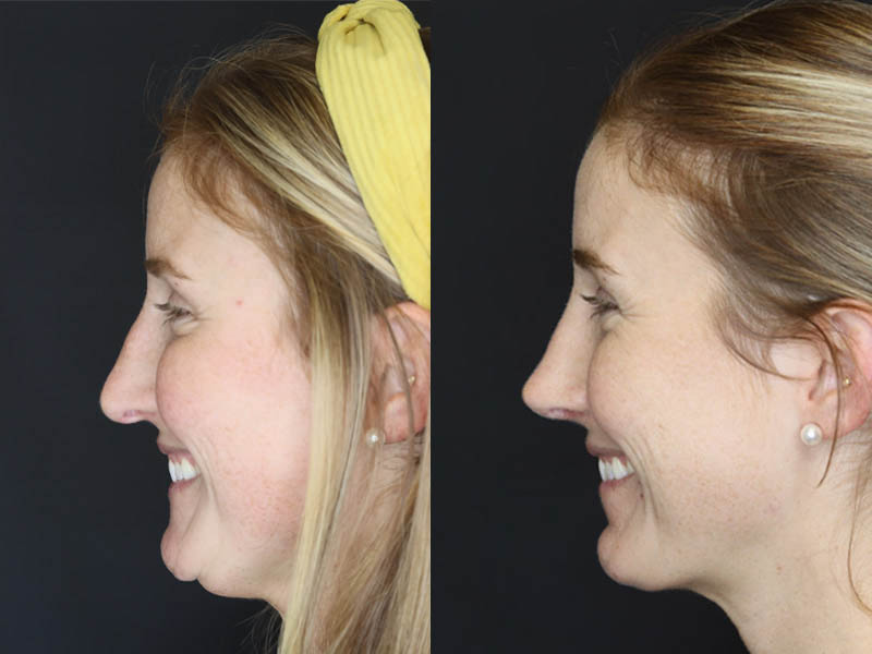 Revision Rhinoplasty case #4221