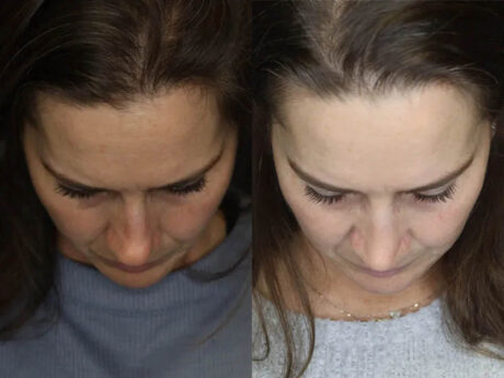 Rhinoplasty case #4163