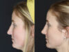 Revision Rhinoplasty case #4221 slider thumbnail