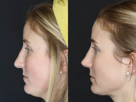 Revision Rhinoplasty case #4221