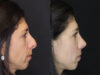 Revision Rhinoplasty case #4230 slider thumbnail