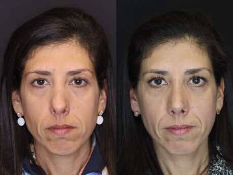 Revision Rhinoplasty case #4230