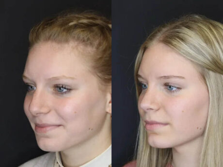 Rhinoplasty case #4237