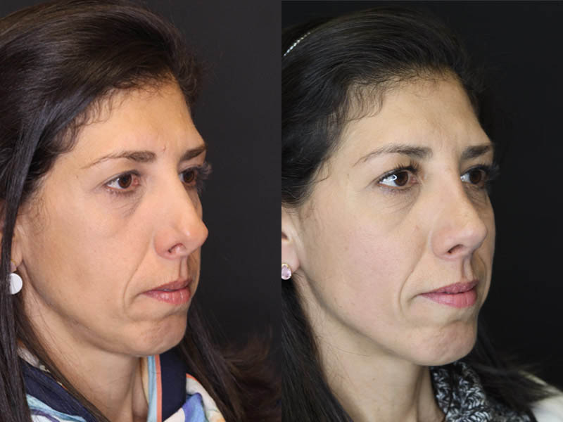 Revision Rhinoplasty case #4230