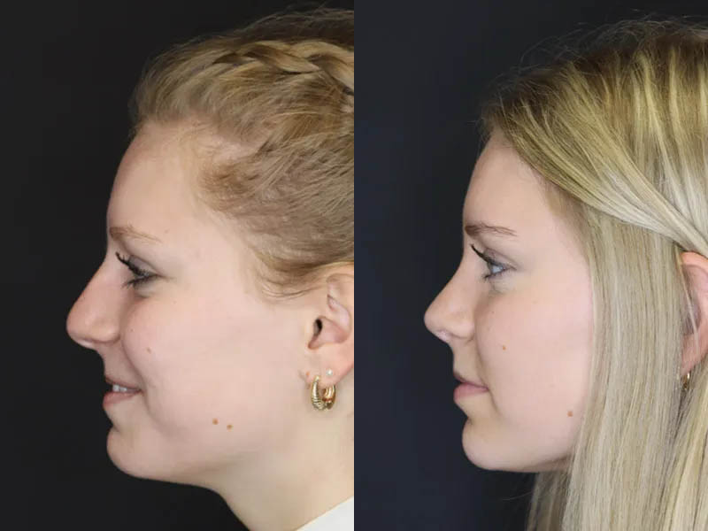 Rhinoplasty case #4237
