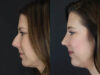 Rhinoplasty case #4252 slider thumbnail