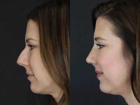 Rhinoplasty case #4252