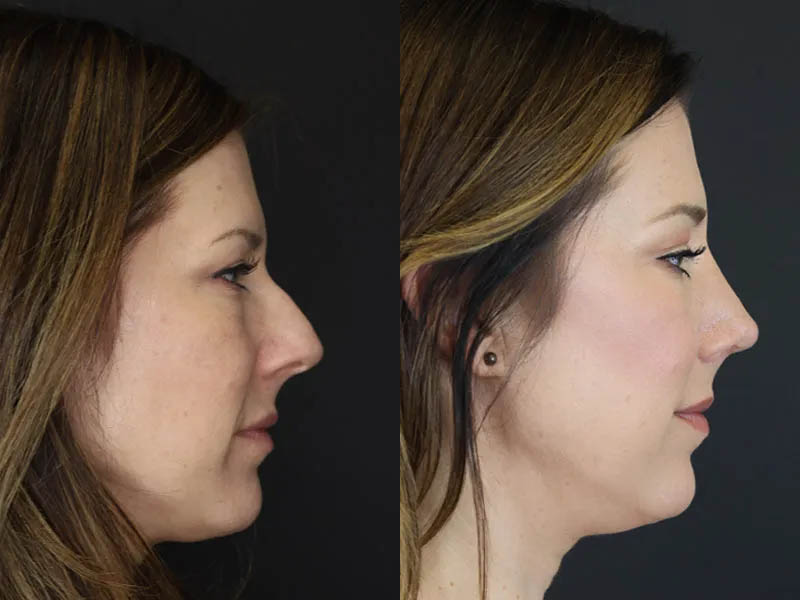 Rhinoplasty case #4252
