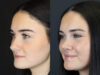 Rhinoplasty case #4321 slider thumbnail