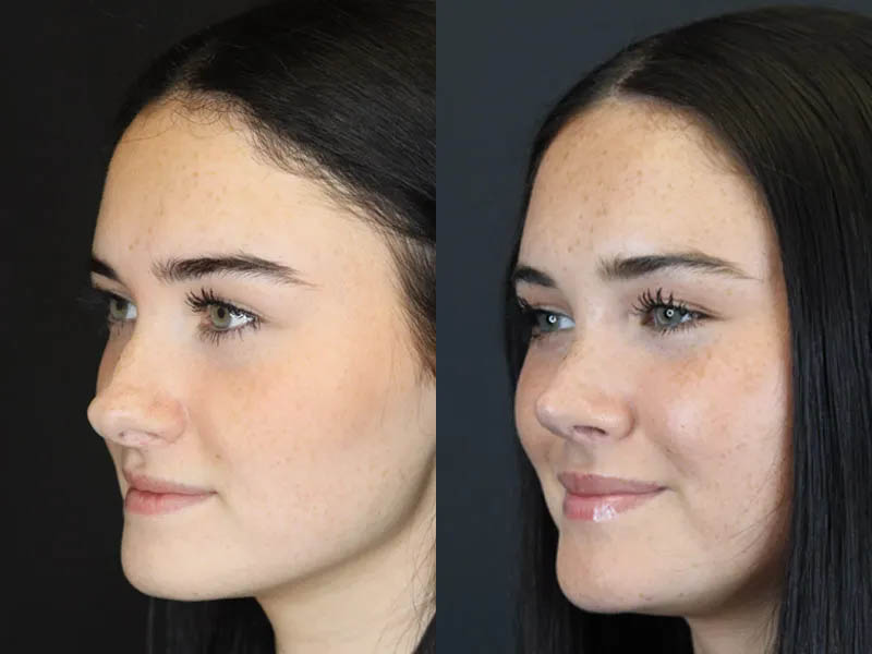 Rhinoplasty case #4321